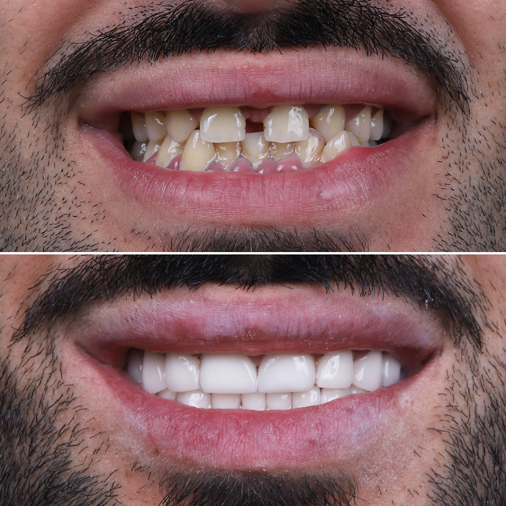 Dental veneers b&a 8