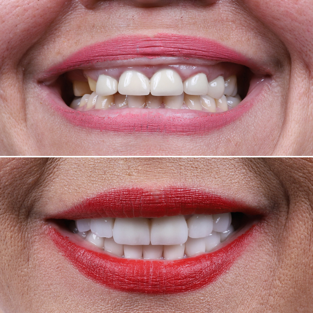 Dental veneers b&a 9