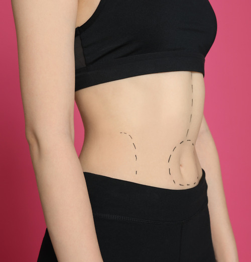 Person with marked abdomen, illustrating post-gastric balloon recovery tips