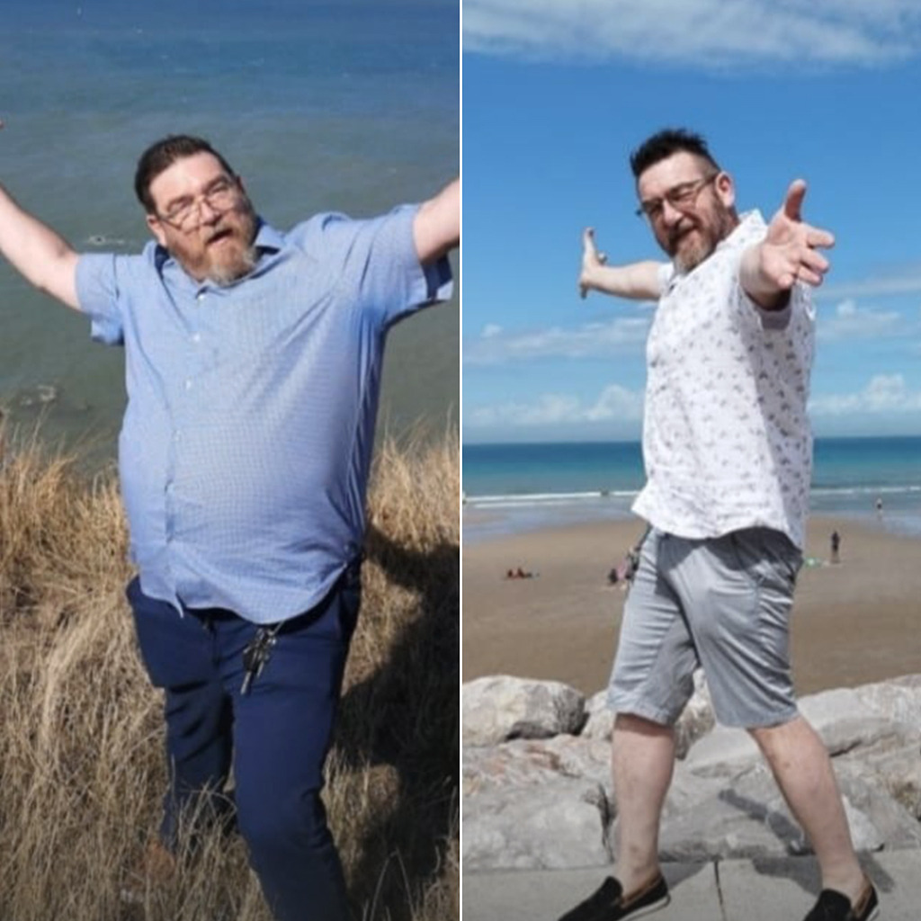 Male gastric balloon before and after – beachside weight loss transformation