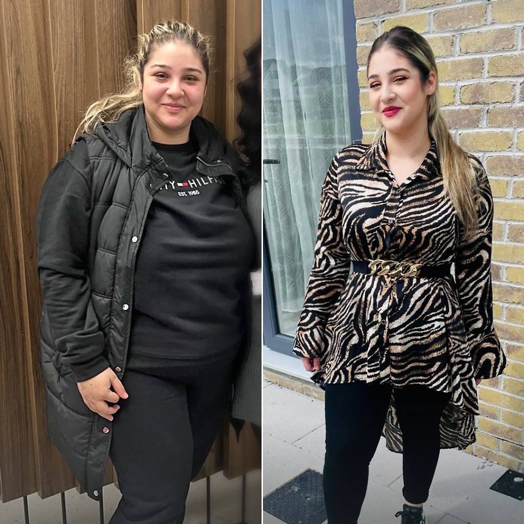 Gastric Sleeve B&A 20