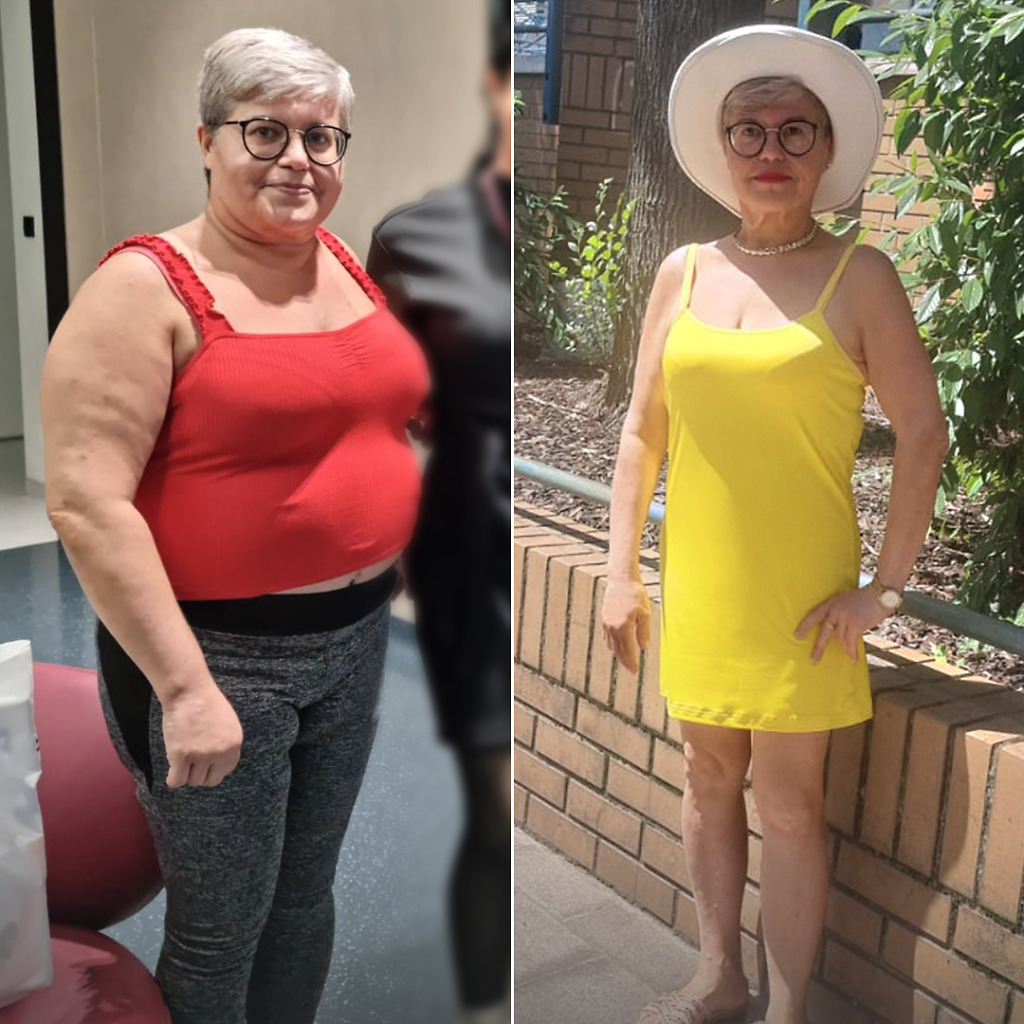 Gastric Sleeve B&A 21