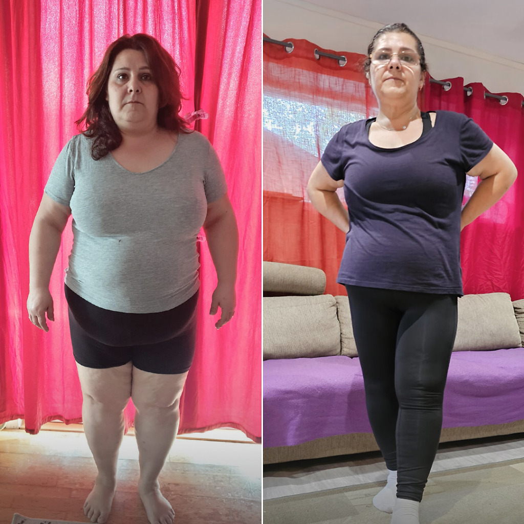 Before and after weight loss – gastric balloon, botox, bypass, and sleeve results