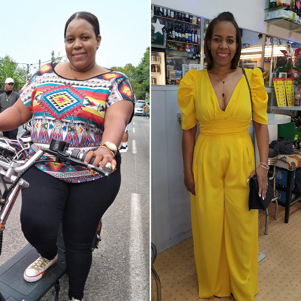 Bariatric patient transformation – post-surgery results