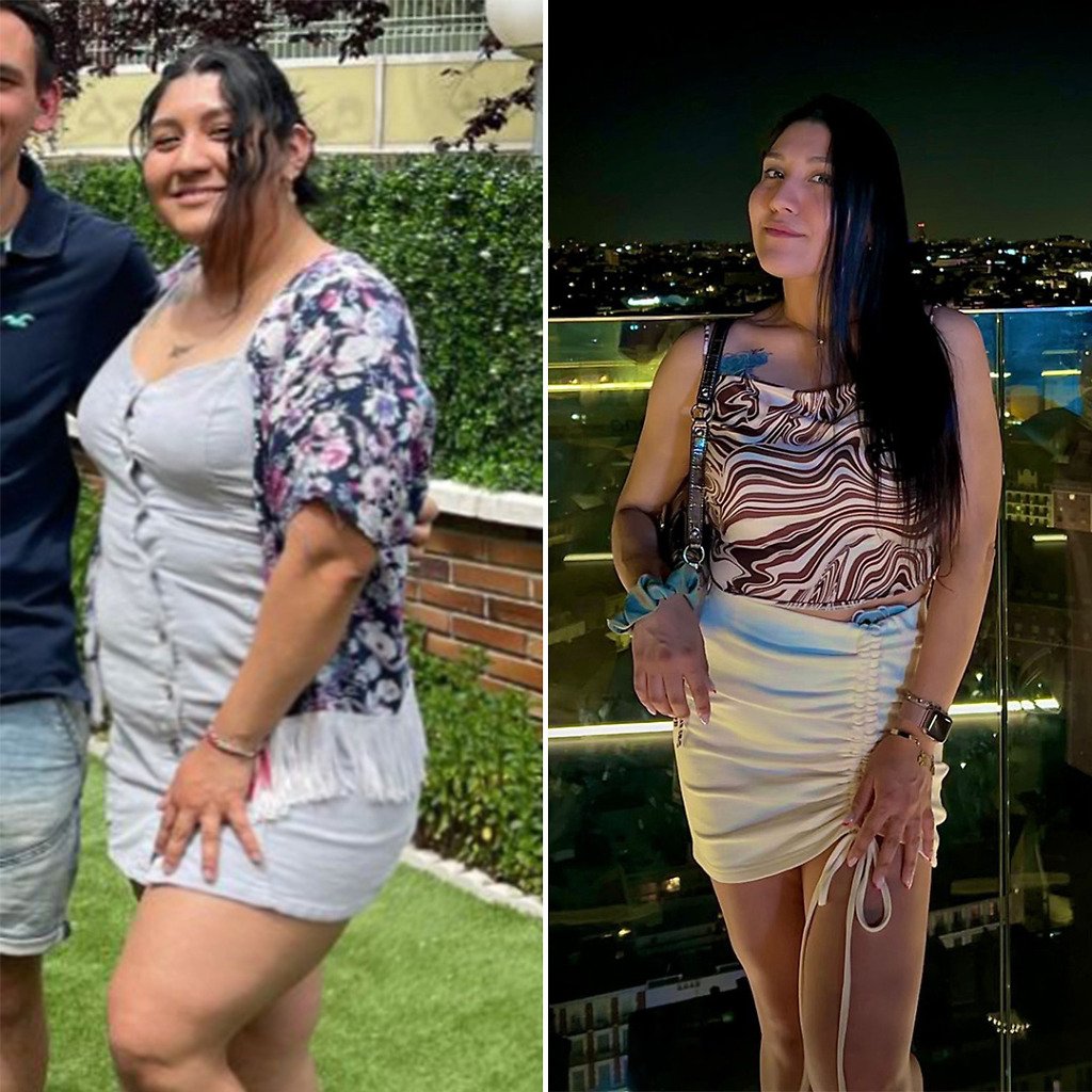 Gastric Sleeve Before & After 12