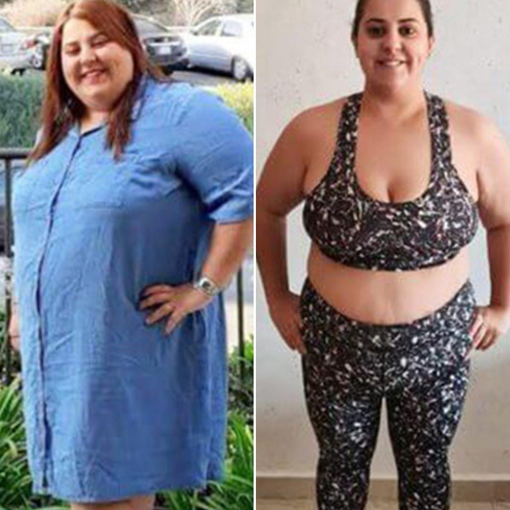 Gastric Sleeve Before & After 13