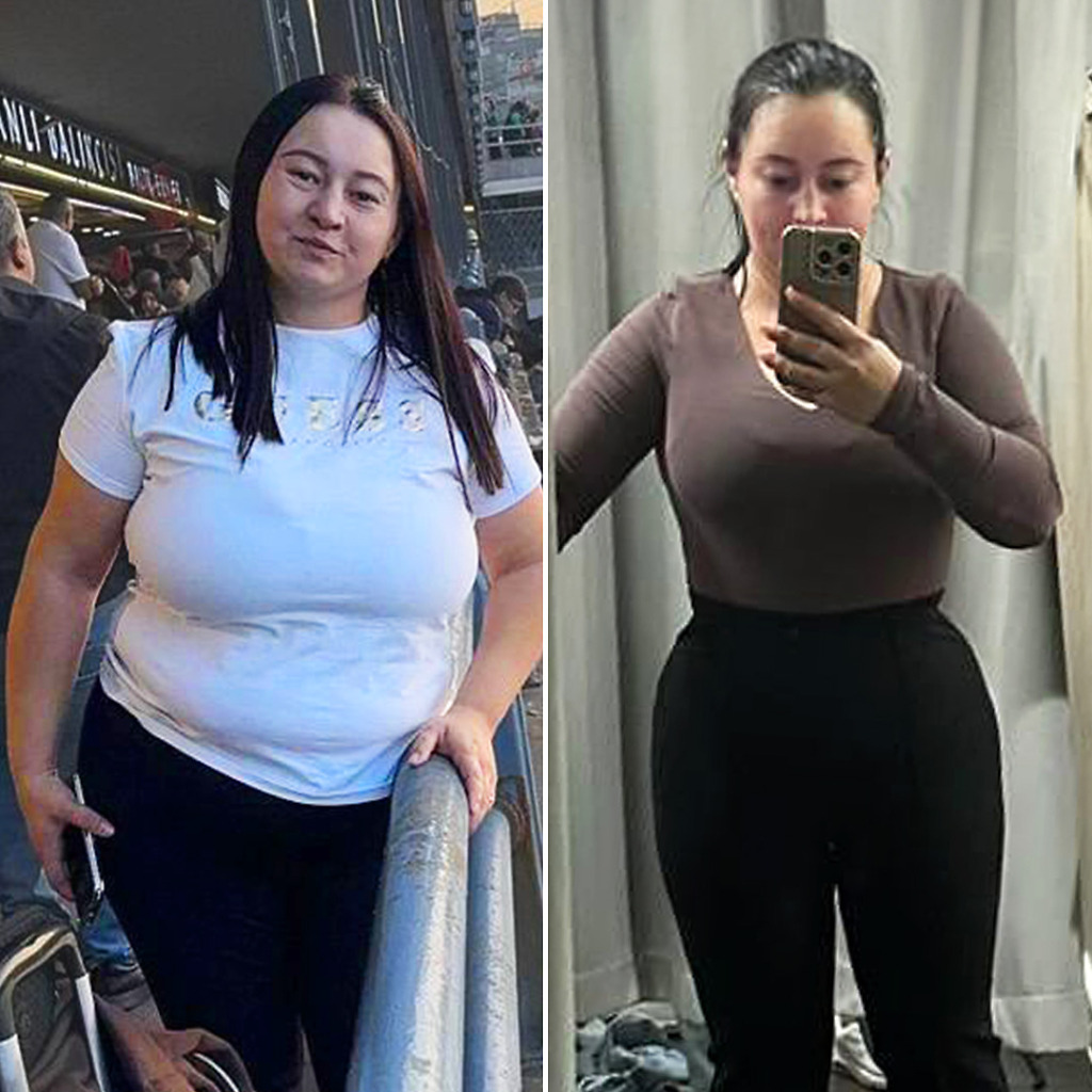 Gastric Sleeve Before & After 14