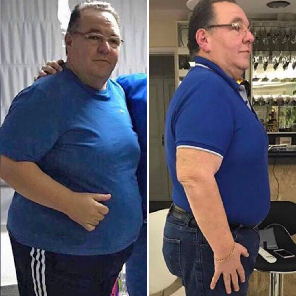 Gastric Sleeve Before & After 17