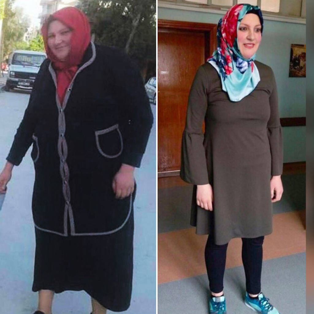 Gastric Sleeve Before & After 18