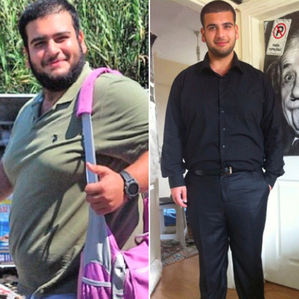 Before and after images of bariatric weight loss patients in Turkey