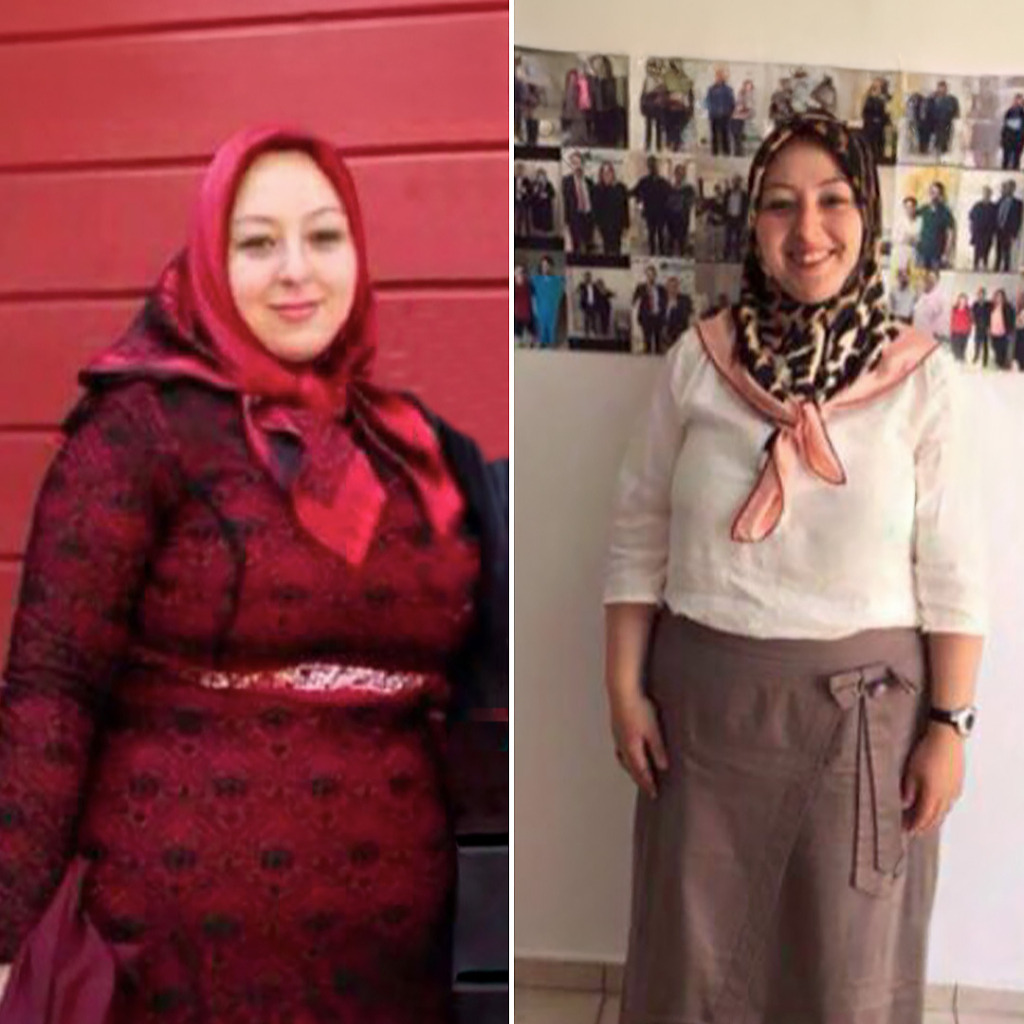 Gastric Sleeve Before & After 2