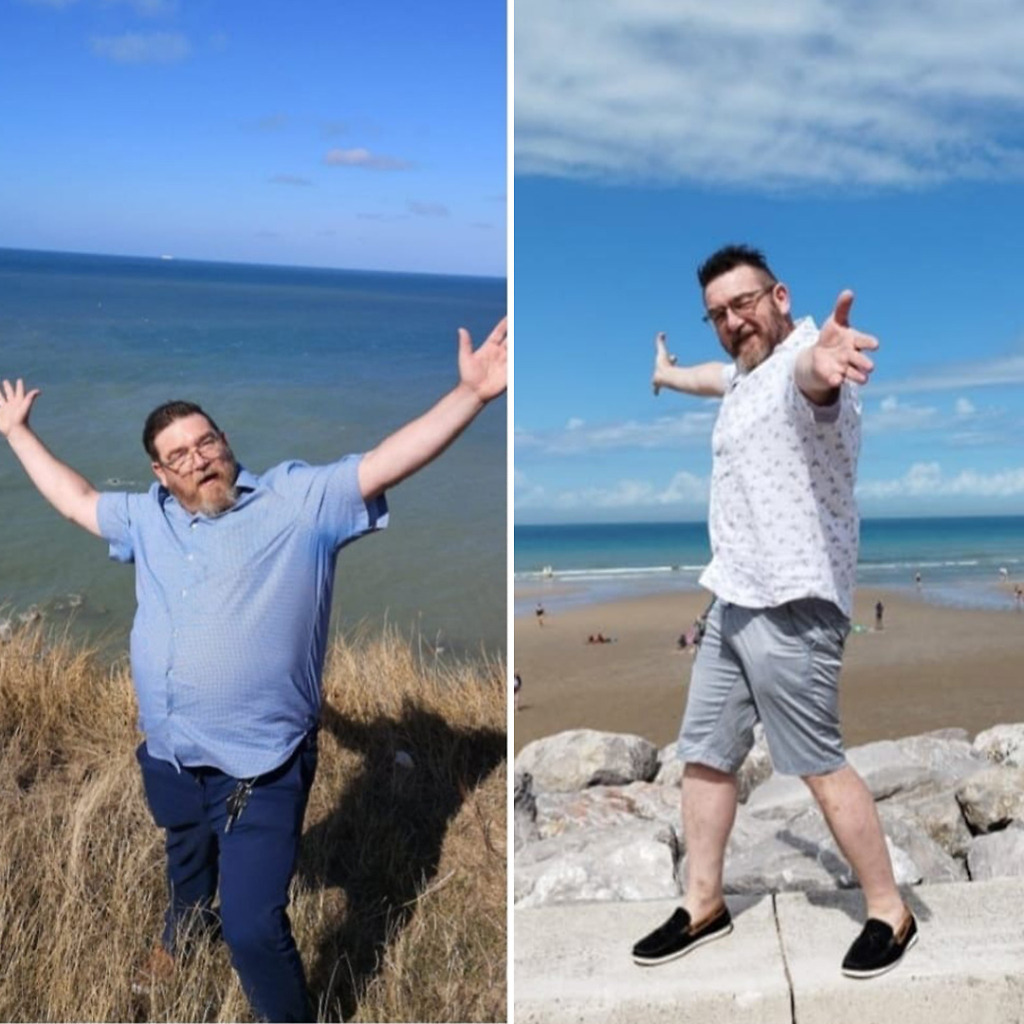 Gastric Sleeve Before & After 20