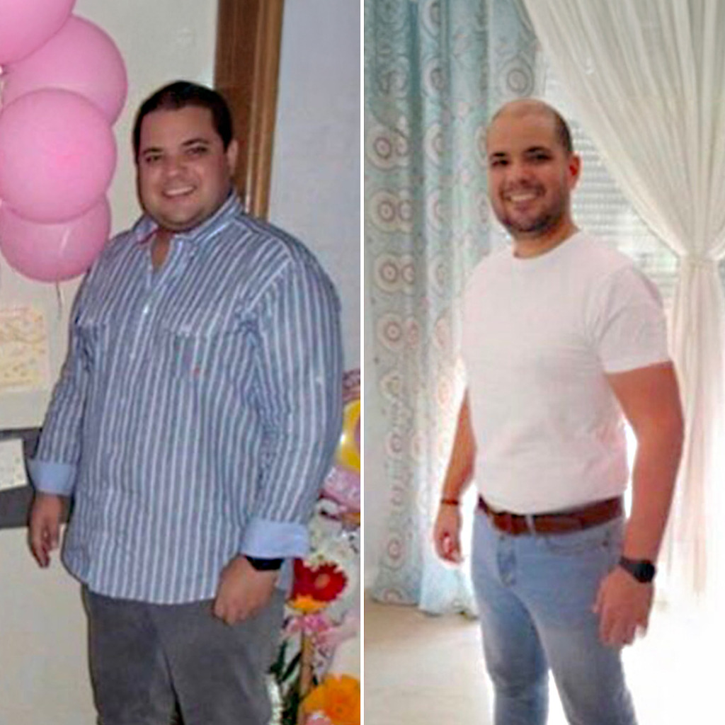 Gastric Sleeve Before & After 3