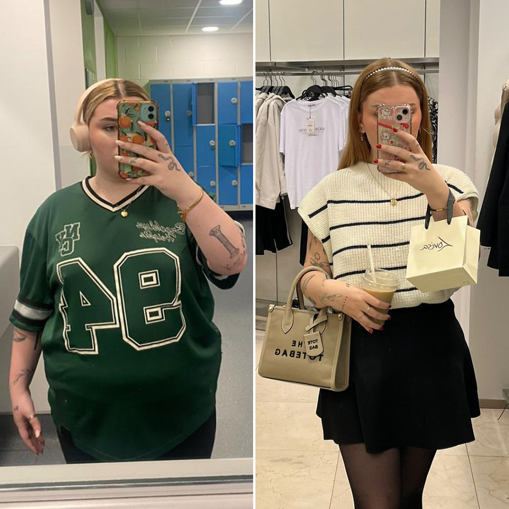 Gastric Sleeve Before & After 4