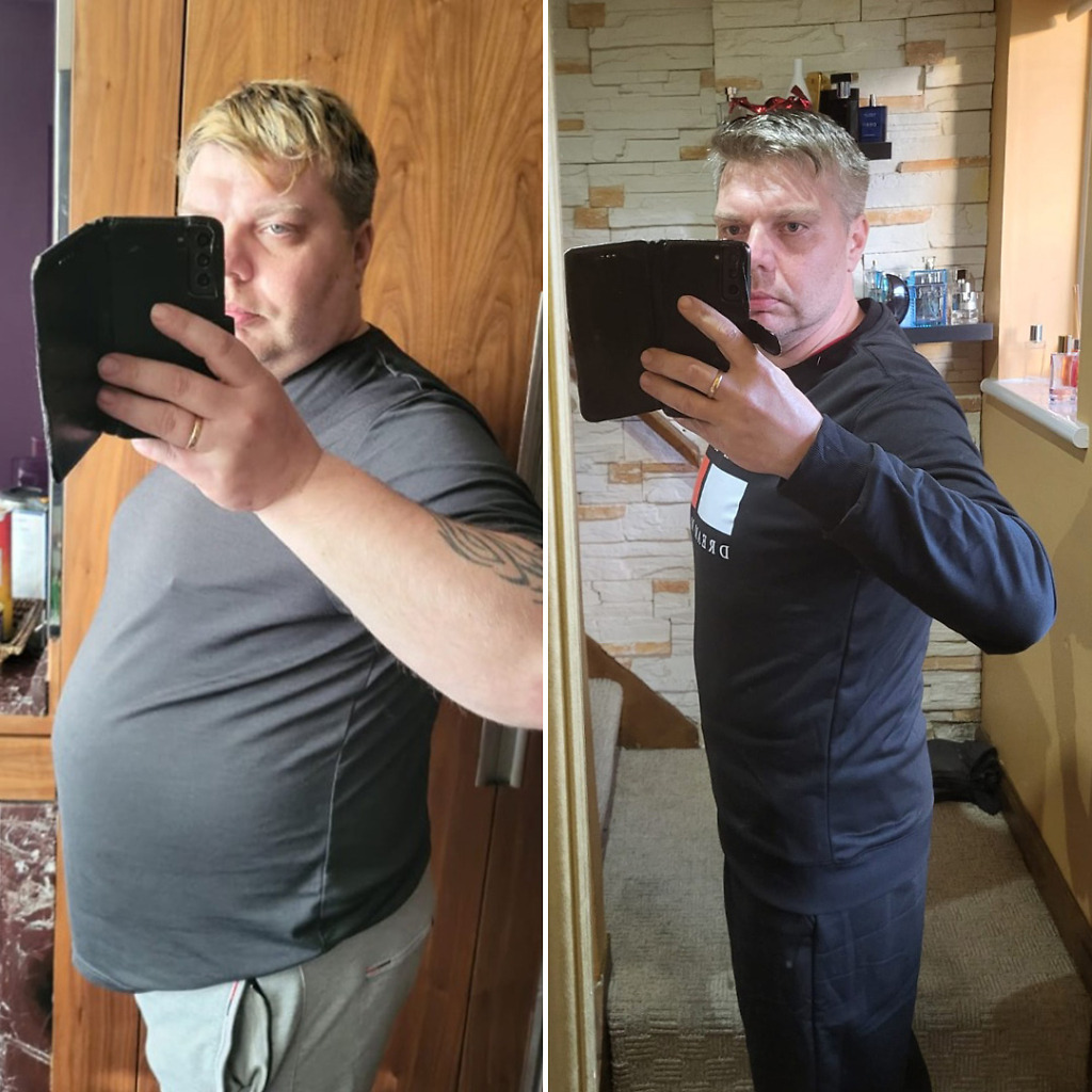 Weight loss progress with gastric botox, balloon, sleeve, and bypass