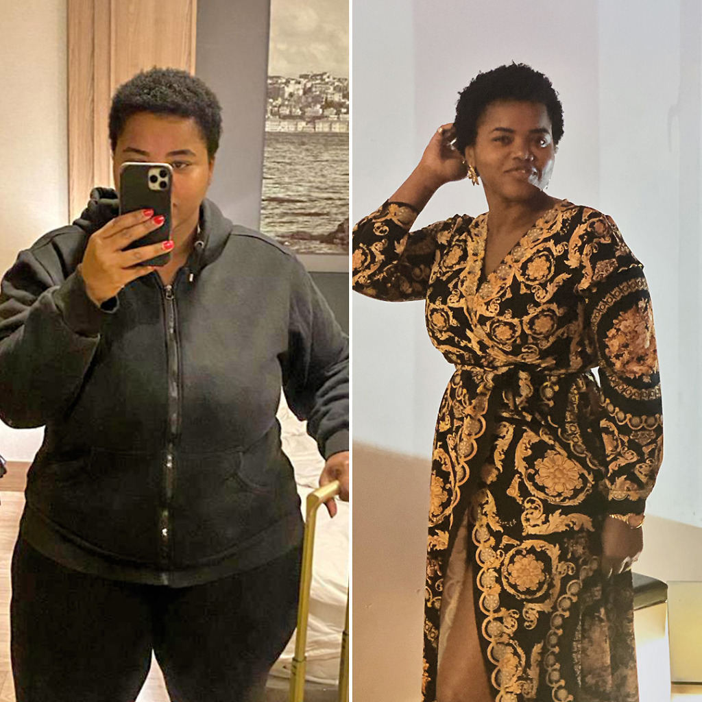 Gastric Sleeve Before & After 7