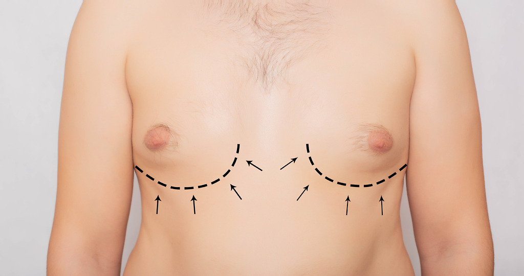 Laser-assisted liposuction for gynecomastia: Precise fat removal with minimal discomfort and quicker healing