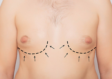 Gynecomastia  scaled e