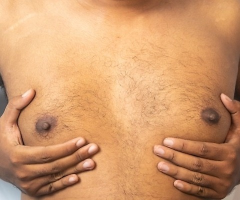 Gynecomastia  scaled e