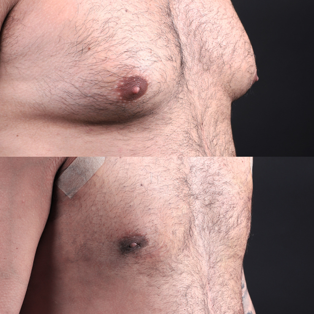 Gynecomastia B&A 1