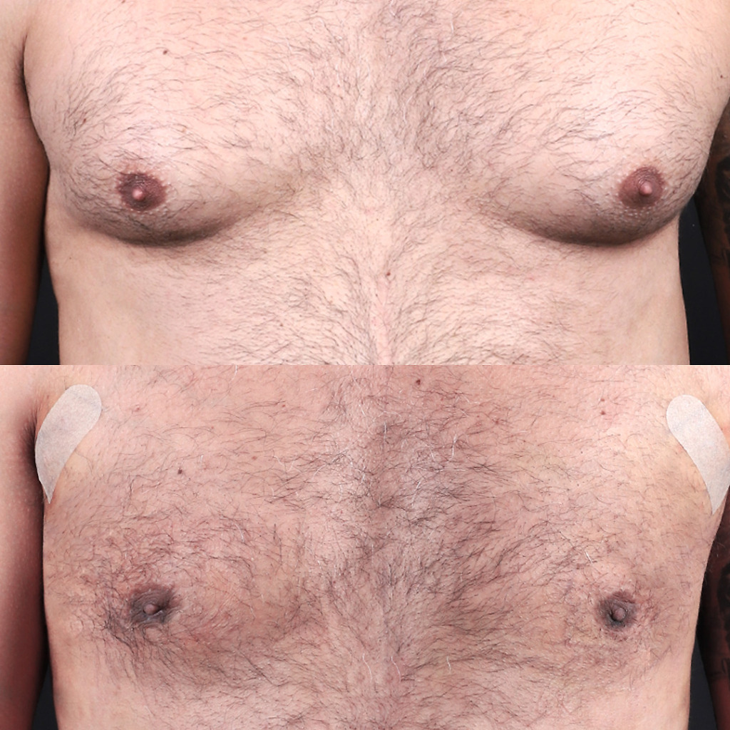 Gynecomastia B&A 2