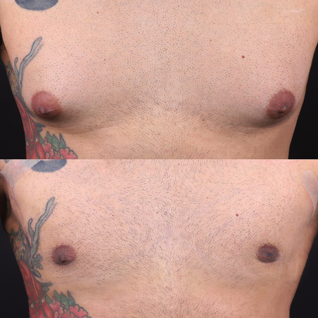 Gynecomastia B&A 3