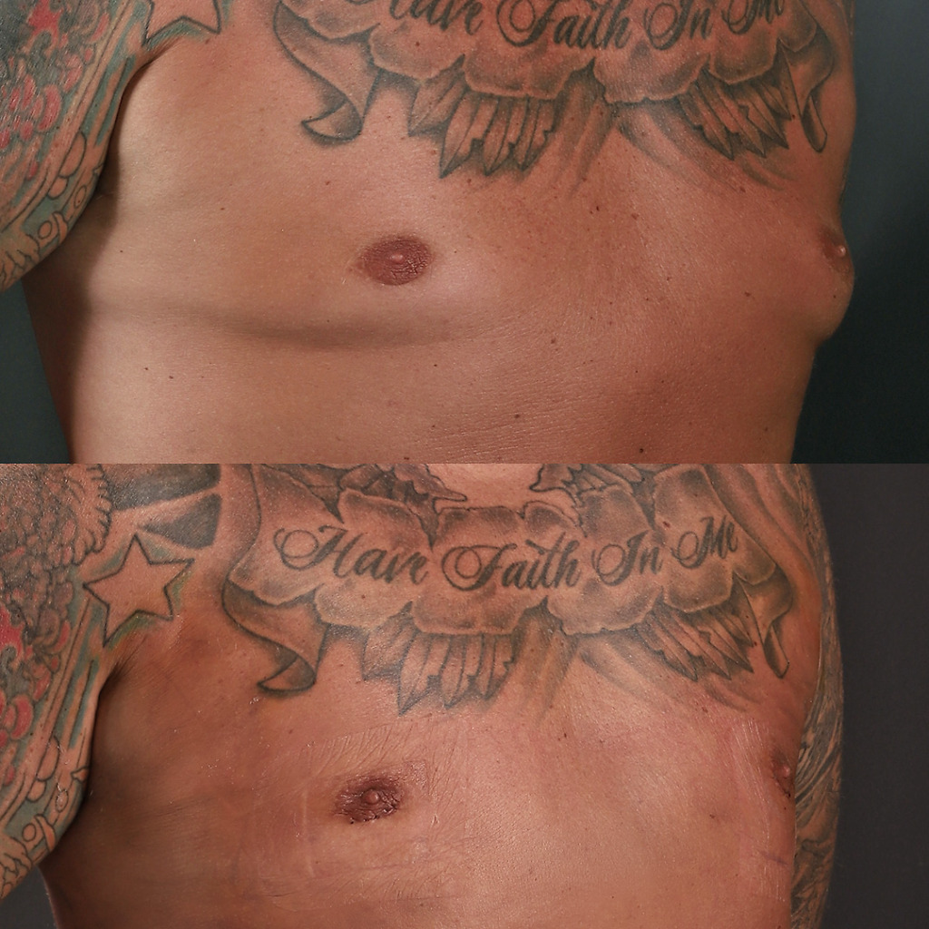 Gynecomastia B&A 4