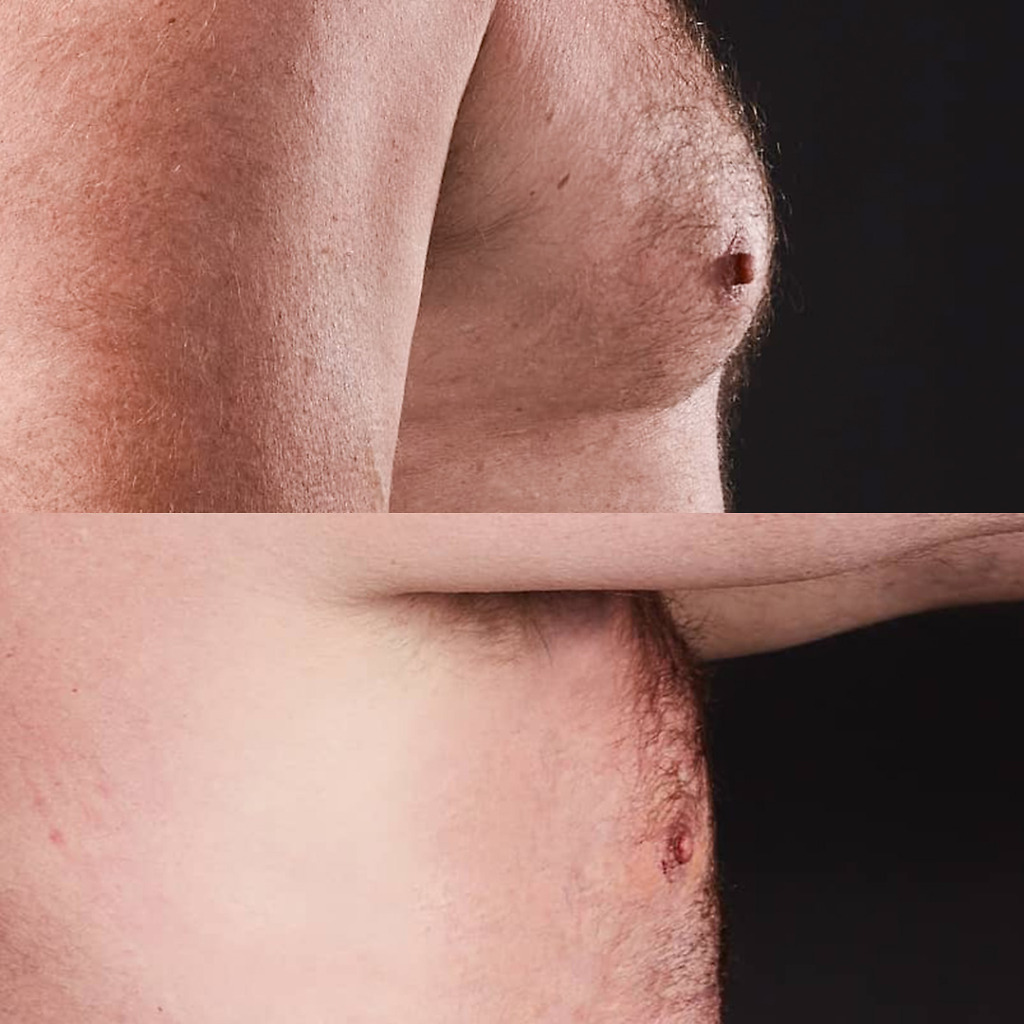 Gynecomastia B&A 5