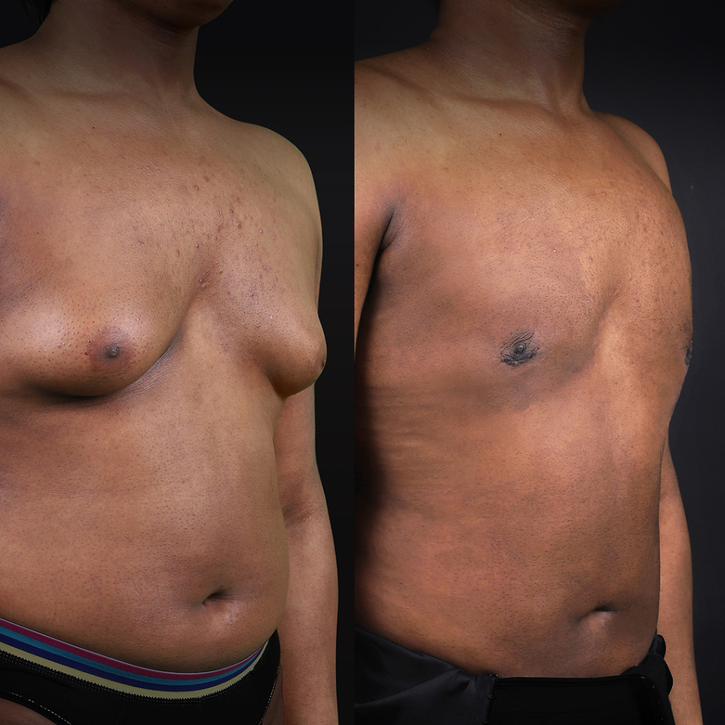 Gynecomastia B&A 6