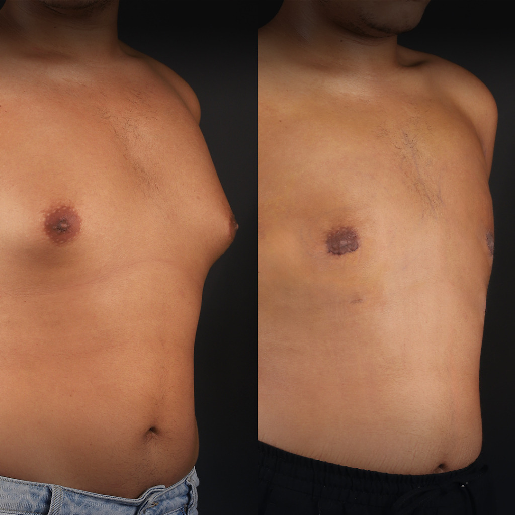 Gynecomastia B&A 7