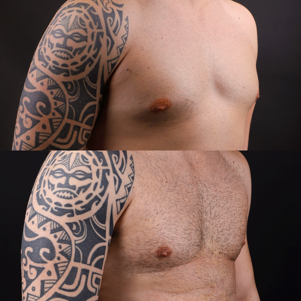 Gynecomastia B&A 8