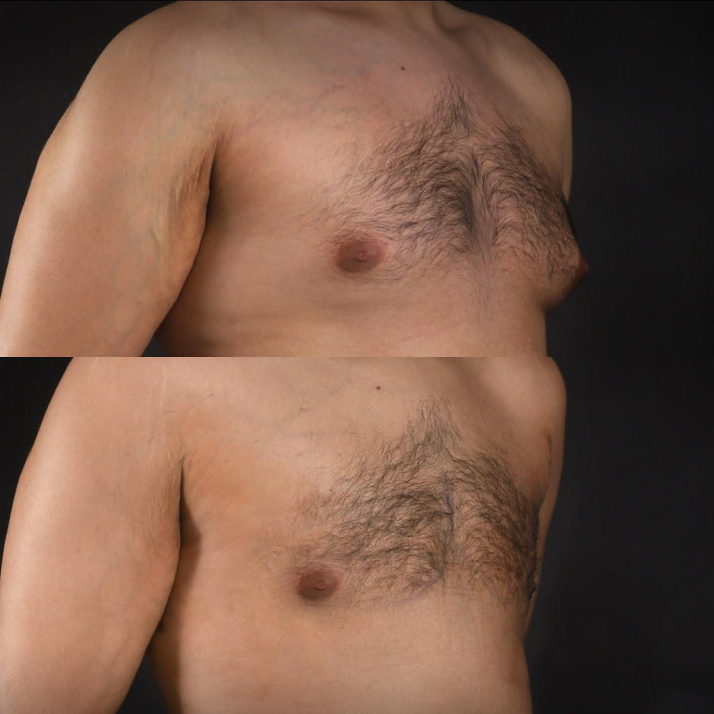 Gynecomastia B&A 9