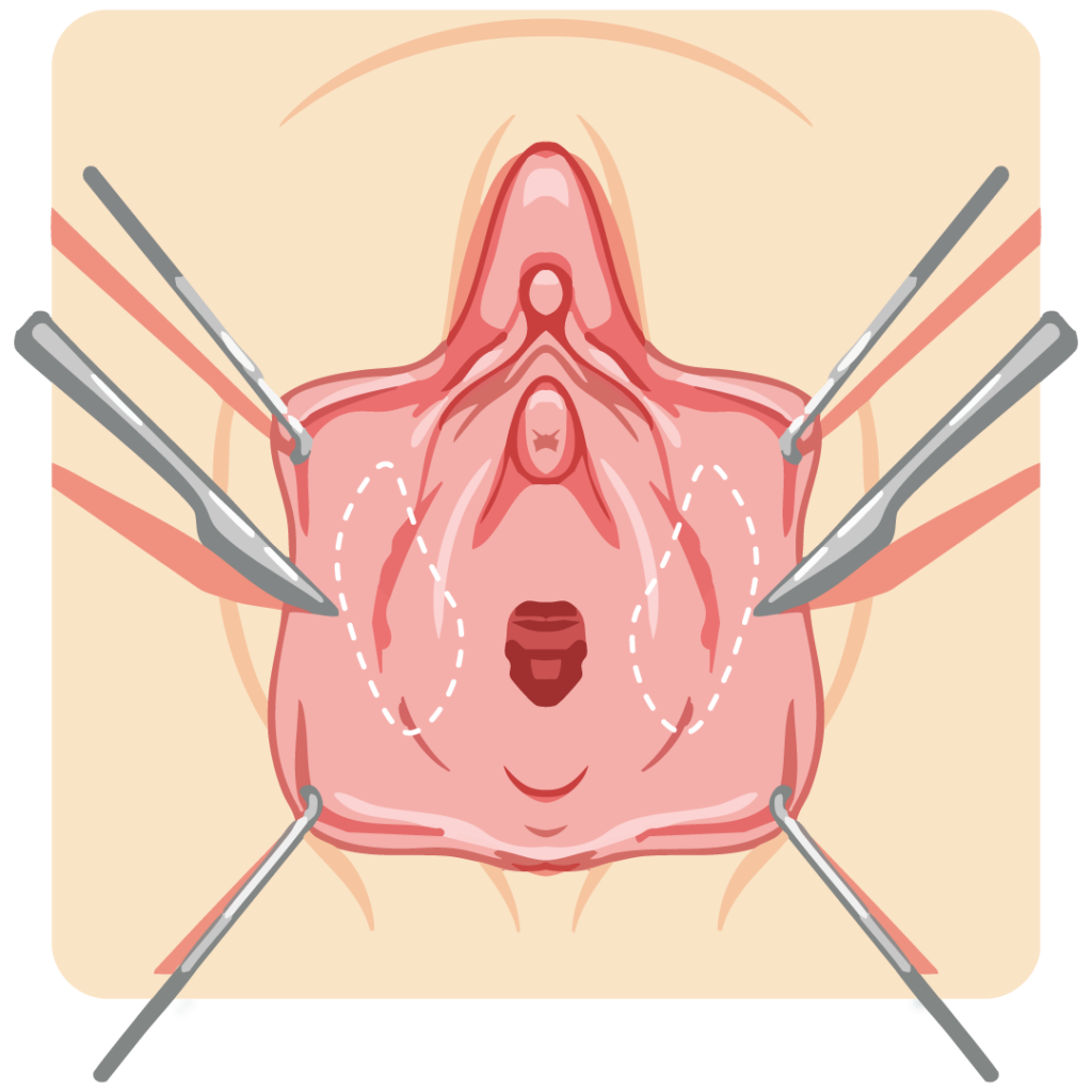 De-epithelialization labiaplasty diagram removing the outer skin layer