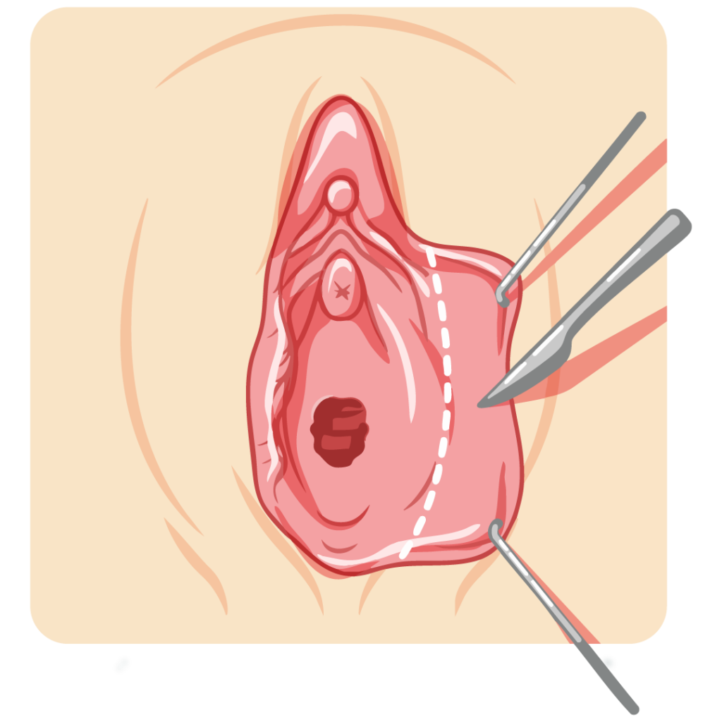 Trim (edge excision) labiaplasty diagram removing excess labial tissue