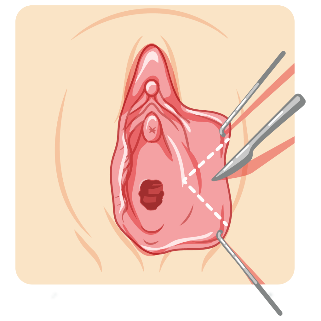 Wedge excision labiaplasty diagram removing wedge-shaped tissue