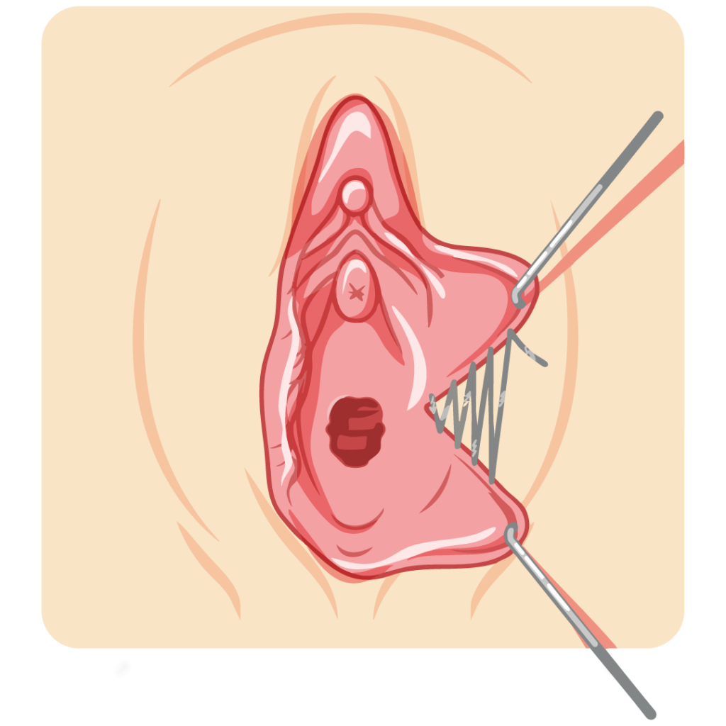 Mid-procedure wedge excision highlighting tissue removal and shape correction