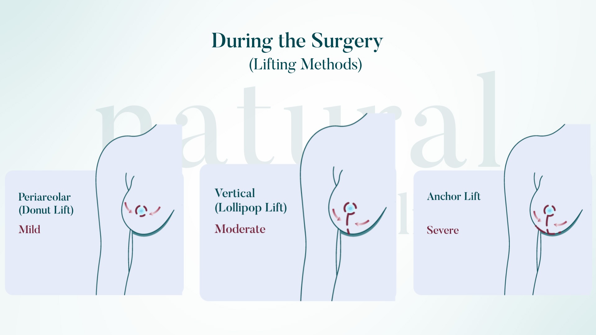 Breast lift techniques infographic showing methods for mild, moderate, and severe sagging