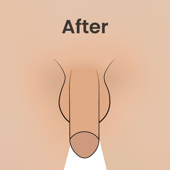 After image of penis lengthening surgery showing the increased flaccid length