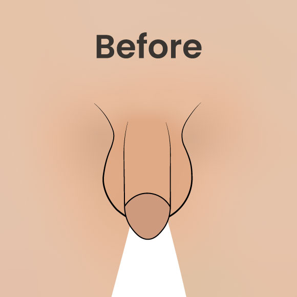 Penis Lengthening Turkey before and after