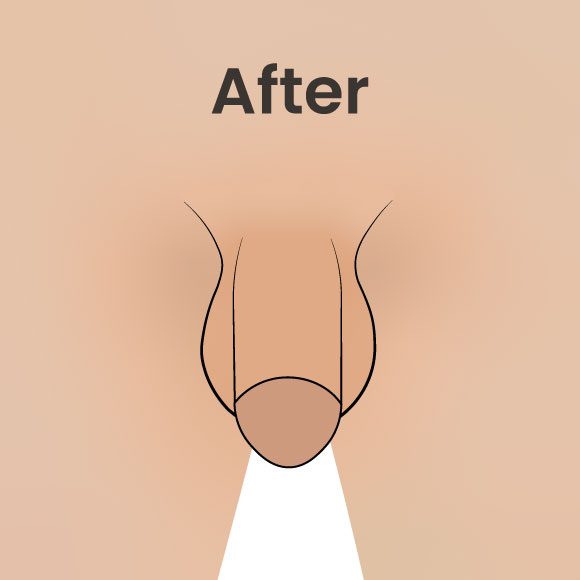 After image showing enhanced girth following penis thickening with fat transfer or fillers