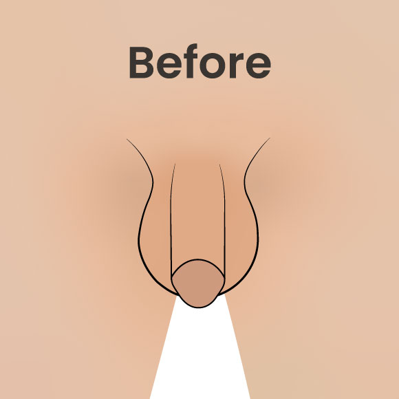 Before image showing the natural state before undergoing penis thickening with fat transfer or fillers