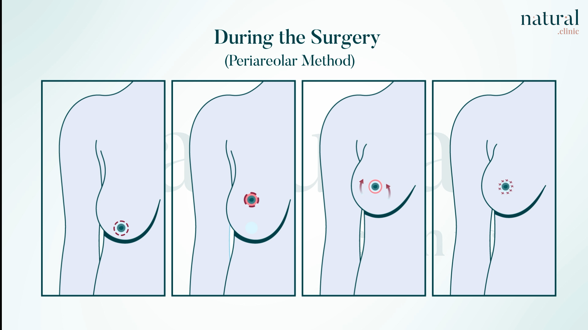 Periareolar lift (donut lift) infographic for mild breast sagging (Grade 1 ptosis)