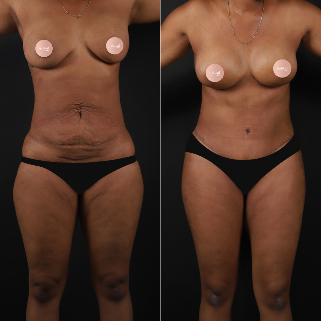 Tummy tuck before after 1