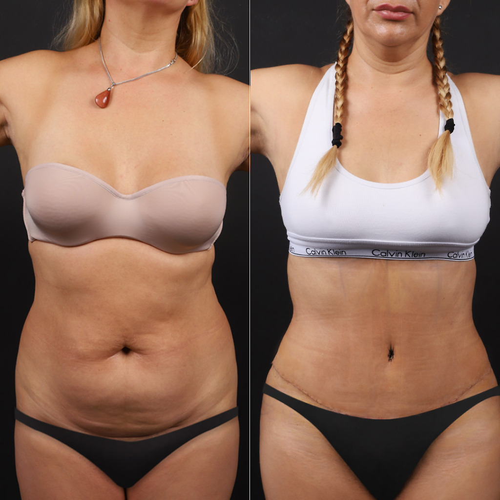 Tummy tuck before after 2