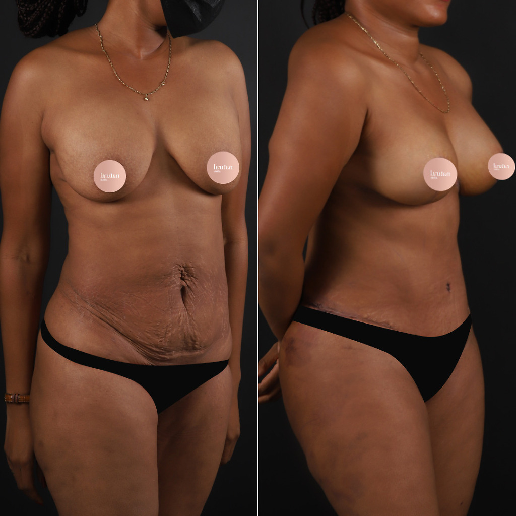 Tummy tuck before after 3