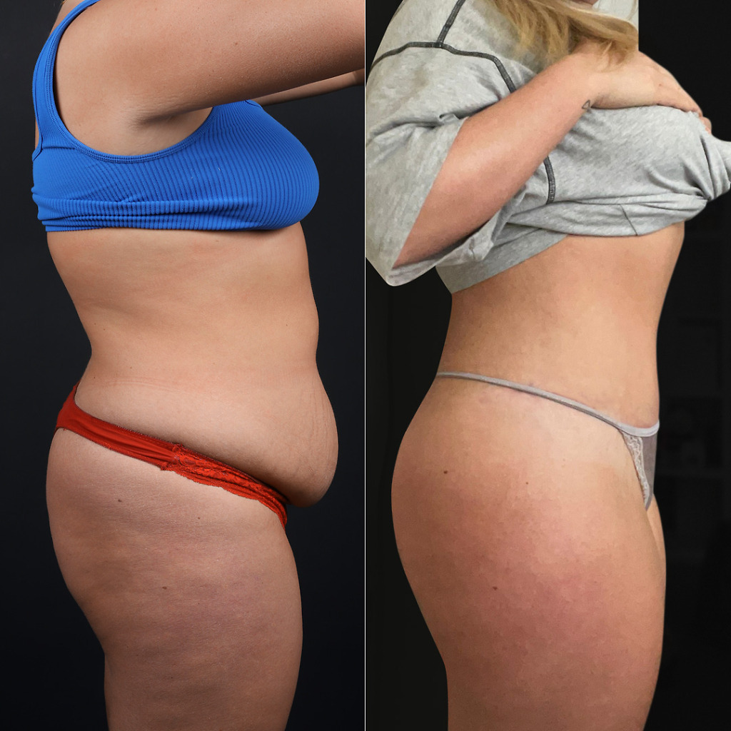 Tummy tuck before after 4