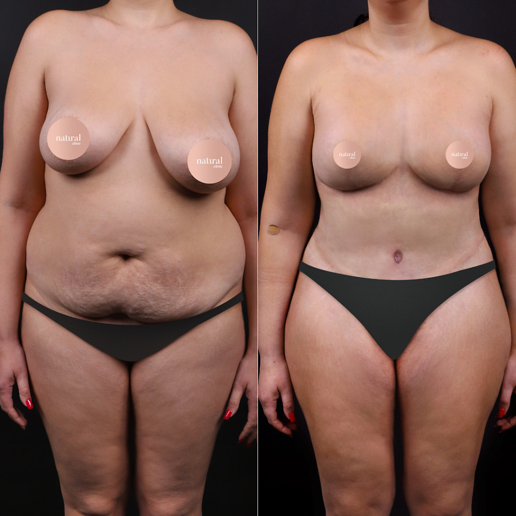 Tummy tuck before after 5