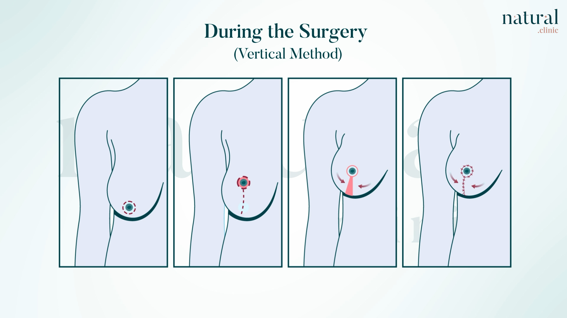 Vertical and anchor lift techniques for moderate to severe breast sagging explained