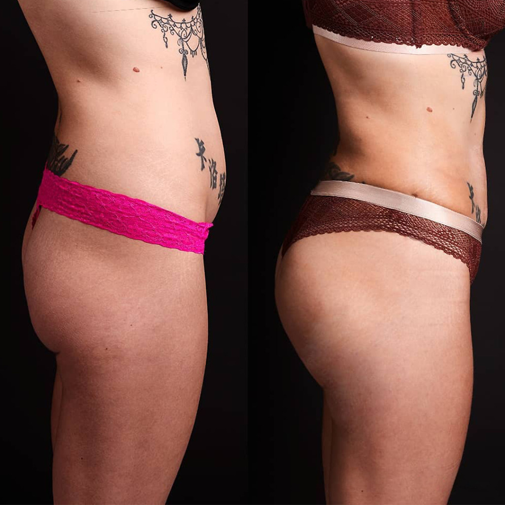 Before and after Brazilian Butt Lift at Natural Clinic in Turkey, side view