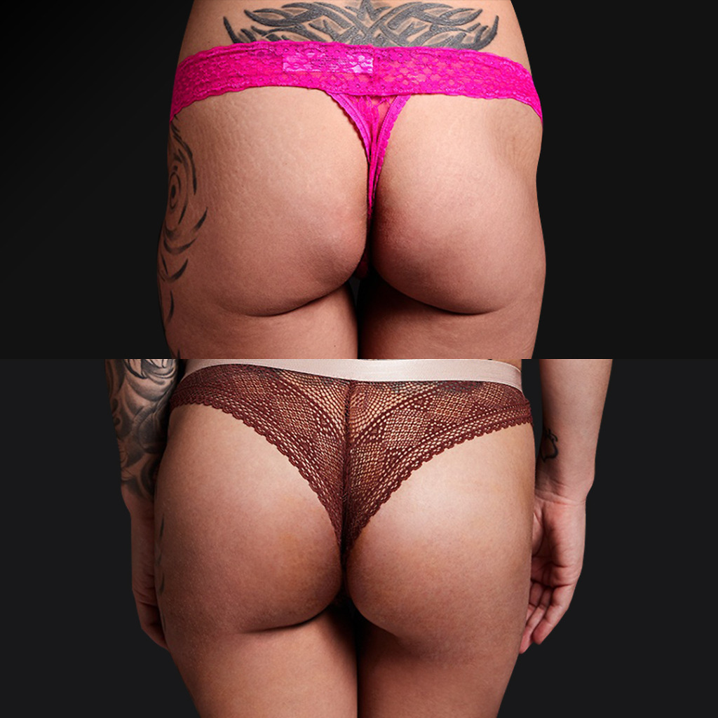 Before and after Brazilian Butt Lift in Turkey, back view highlighting new curves